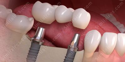 implant films